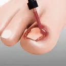 ANTI HONGO TOENAILPLUS